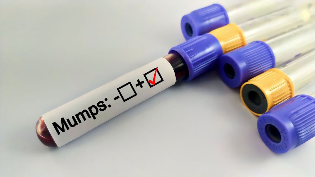 Mumpsz. A laboratóriumi vizsgálatokkal tudják igazolni a vírus jelenlétét