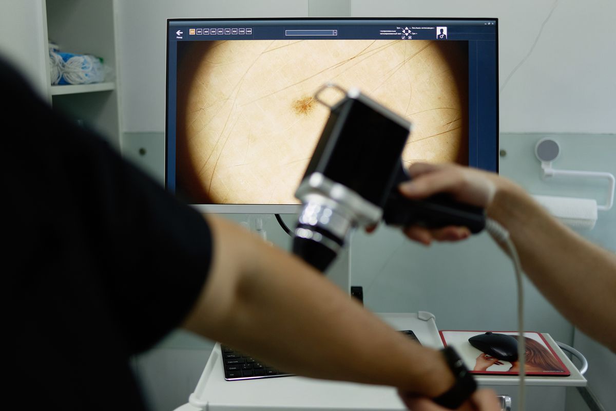 melanoma