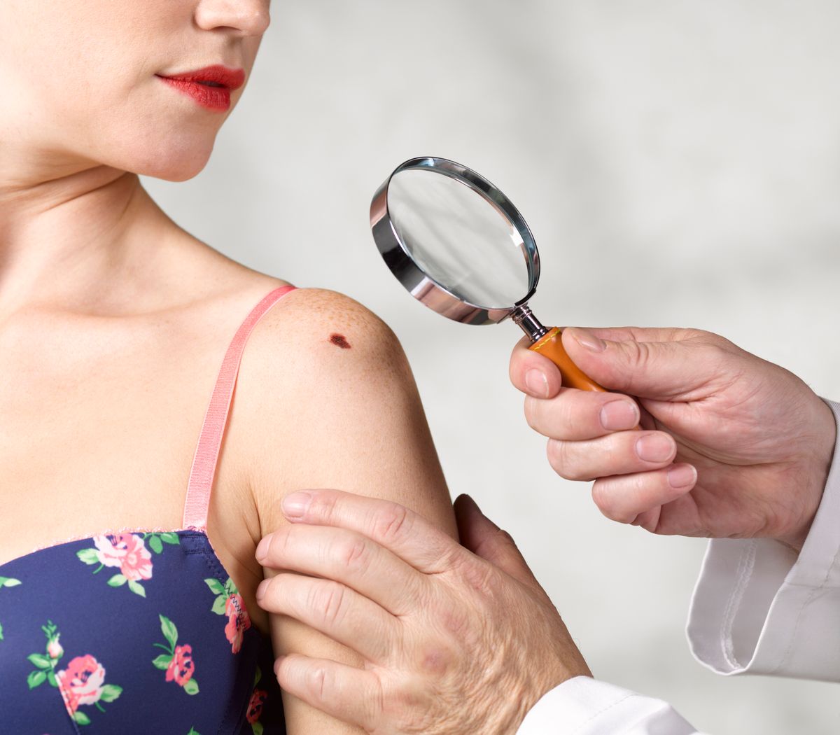 melanoma