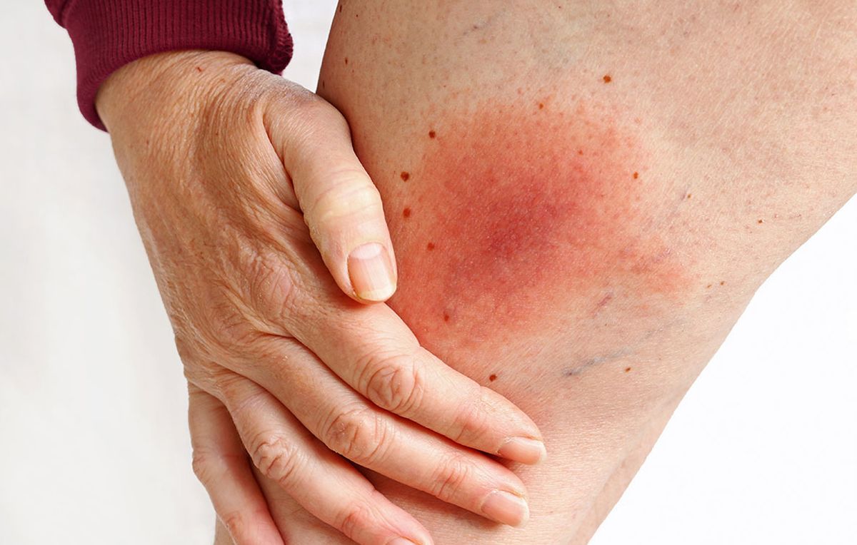 Lyme-kór. Legjellegzetesebb tünete a bőrpír, amely ekkorára is megnőhet